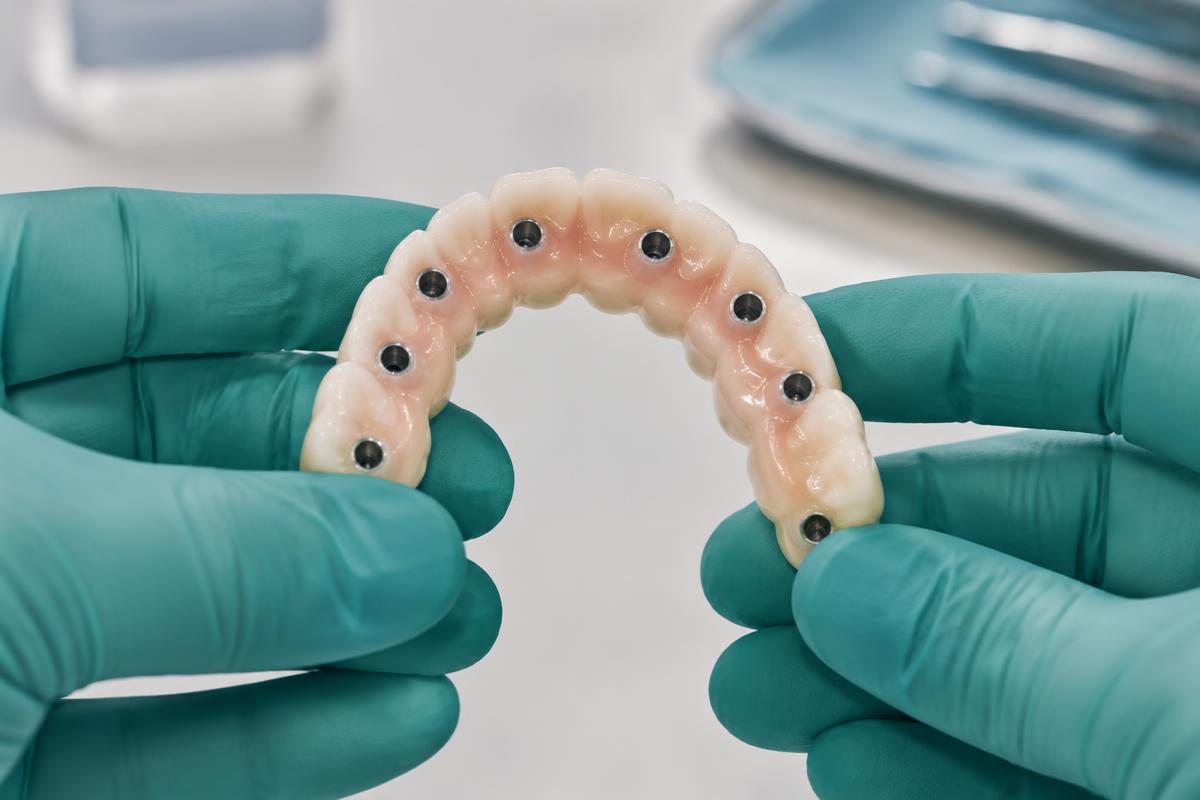 All on 6 dental implants - illustrative photo