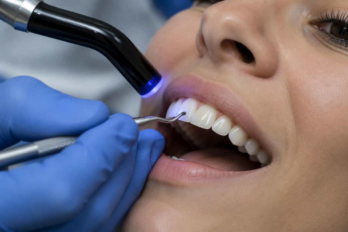 Composite veneers - illustrative photo