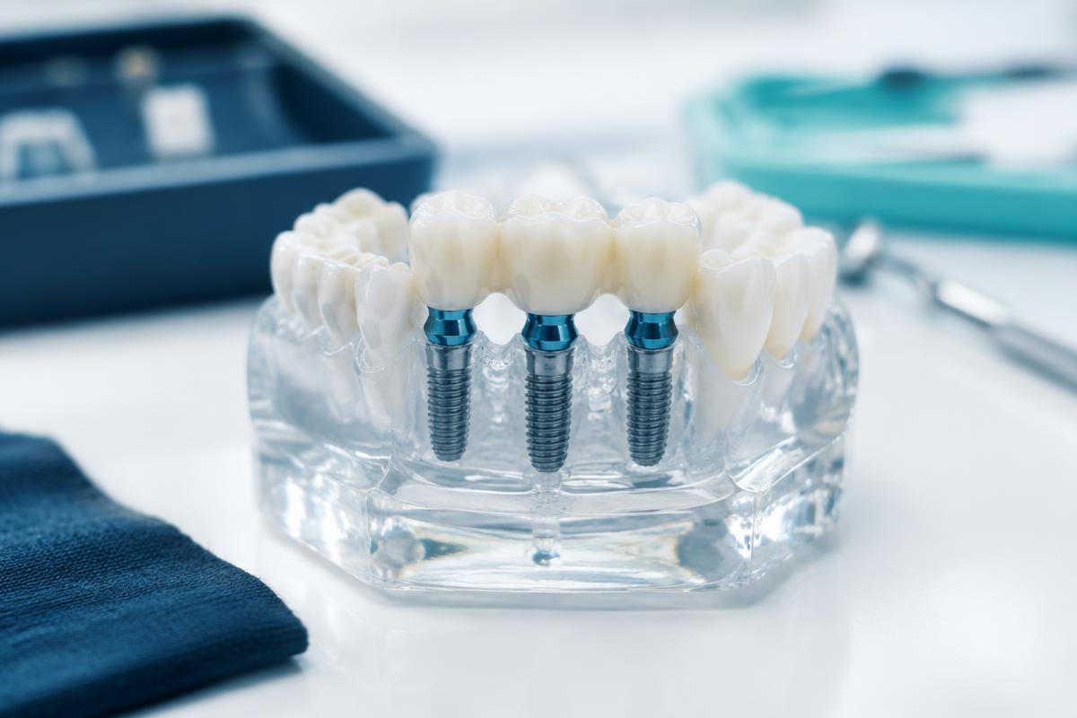 Multiple dental implants - illustrative photo