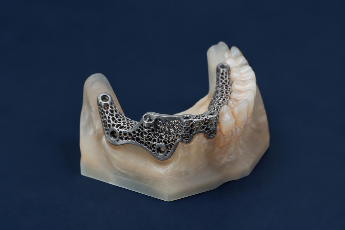 Subperiosteal implants - illustrative photo